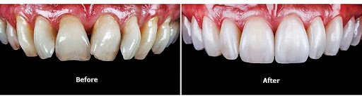 Invisalign treatment before and after